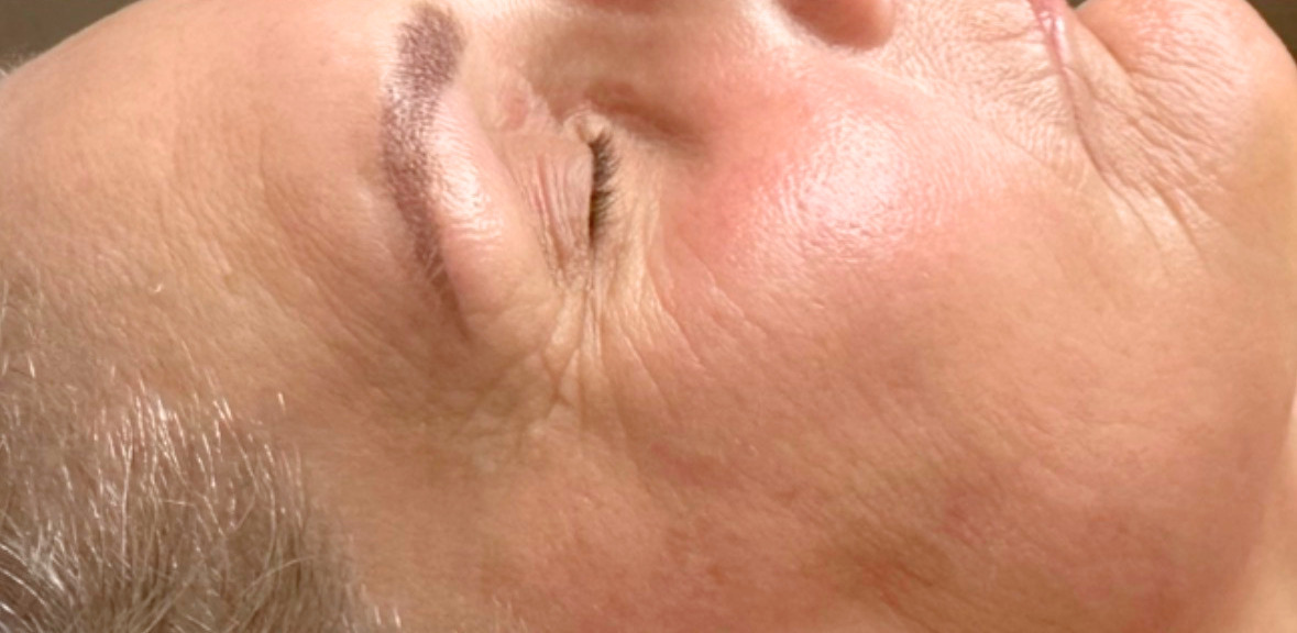 After microneedling