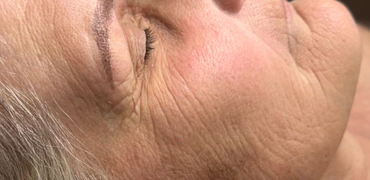 Before microneedling